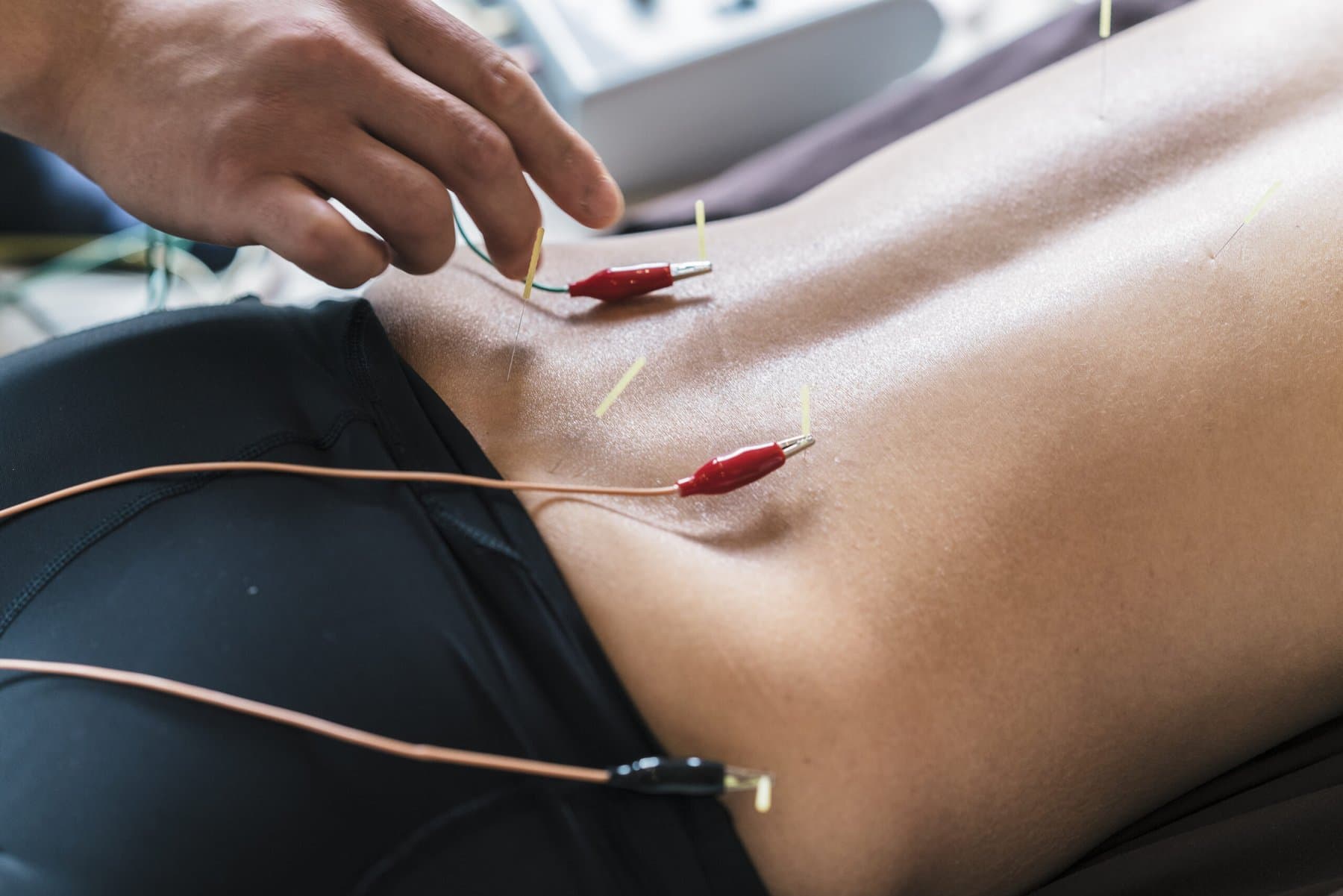 Acupuncture treatment being applied to the upper back