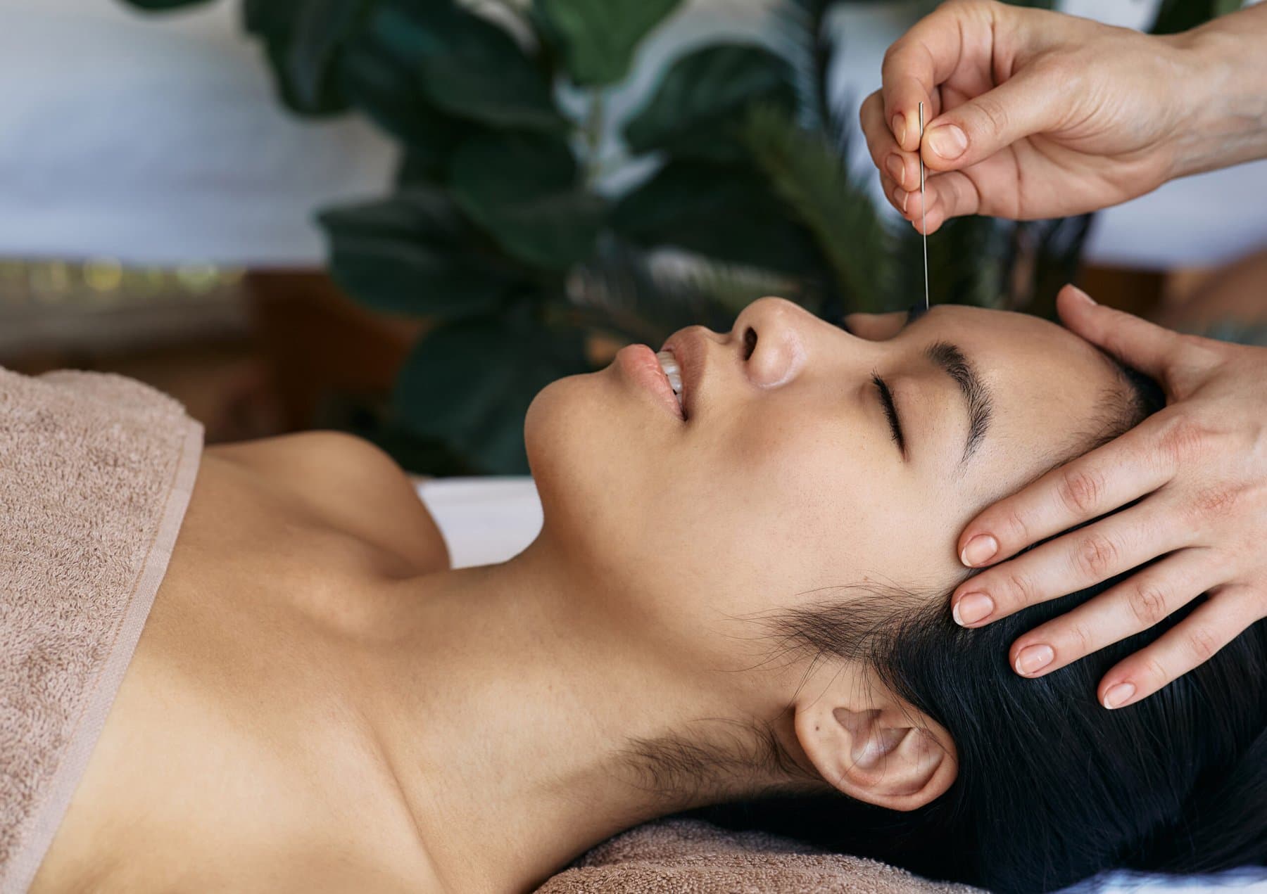 Acupuncture needle being placed near the forehead