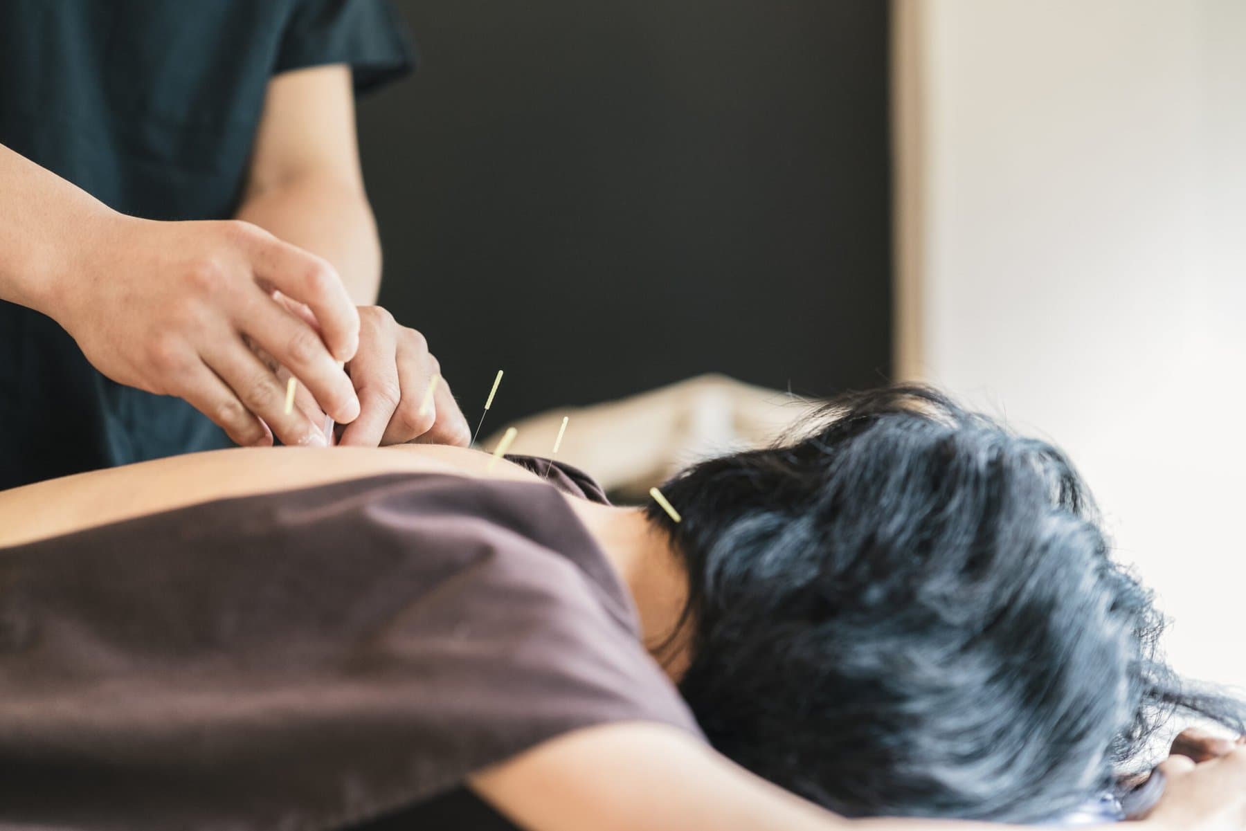 Acupuncture needles being placed during a treatment session