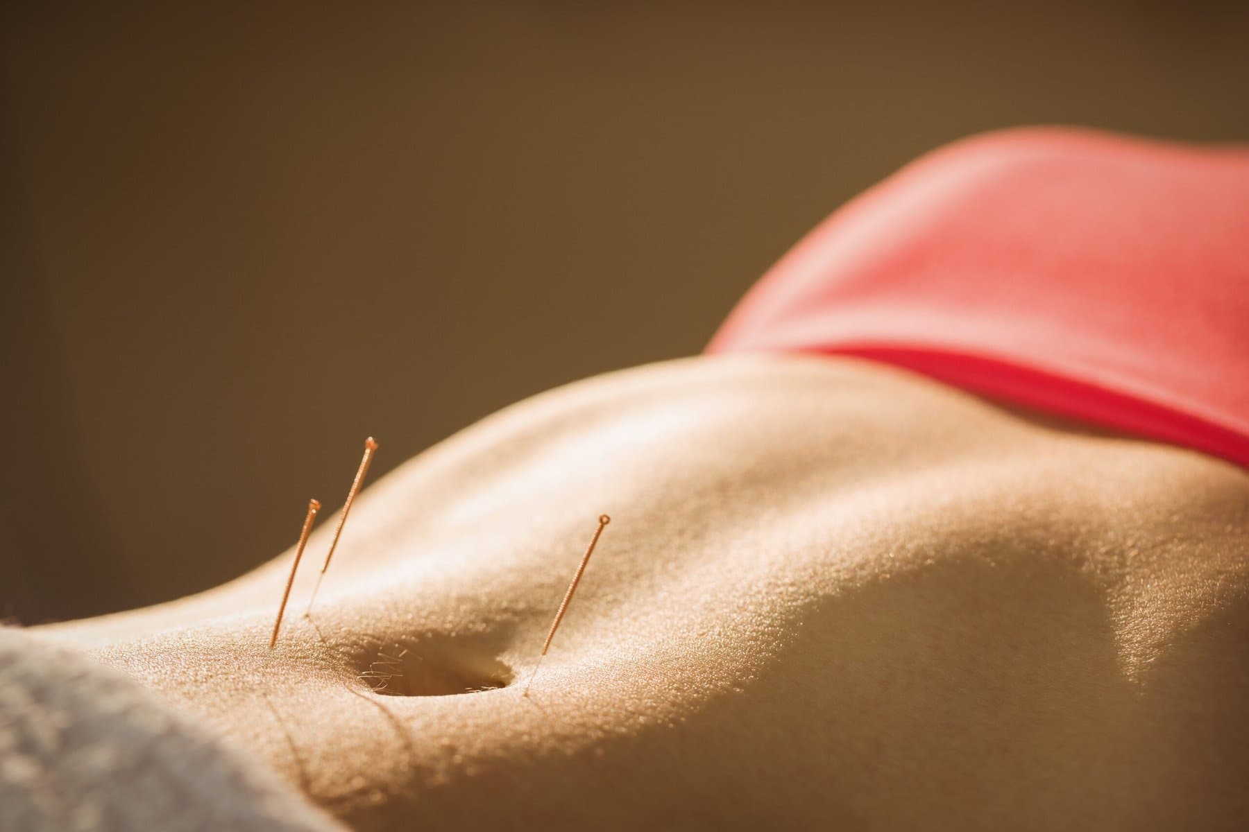Acupuncture treatment session in a calm therapy room